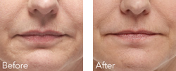 Cosmetic Injections | Photo Gallery | Photo Gallery | Manhattan | New York City (NYC)