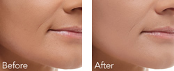 Cosmetic Injections | Photo Gallery | Photo Gallery | Manhattan | New York City (NYC)
