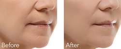 Cosmetic Injections | Photo Gallery | Photo Gallery | Manhattan | New York City (NYC)