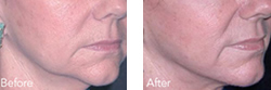 Cosmetic Injections | Photo Gallery | Photo Gallery | Manhattan | New York City (NYC)