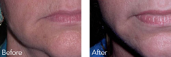 Cosmetic Injections | Photo Gallery | Photo Gallery | Manhattan | New York City (NYC)