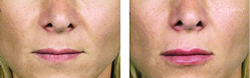 Cosmetic Injections | Photo Gallery | Photo Gallery | Manhattan | New York City (NYC)