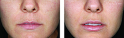 Cosmetic Injections | Photo Gallery | Photo Gallery | Manhattan | New York City (NYC)