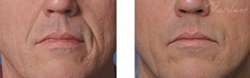 Cosmetic Injections | Photo Gallery | Photo Gallery | Manhattan | New York City (NYC)