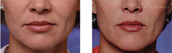 Cosmetic Injections | Photo Gallery | Photo Gallery | Manhattan | New York City (NYC)