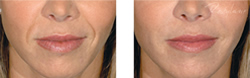 Cosmetic Injections | Photo Gallery | Photo Gallery | Manhattan | New York City (NYC)