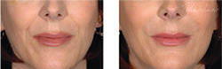 Cosmetic Injections | Photo Gallery | Photo Gallery | Manhattan | New York City (NYC)